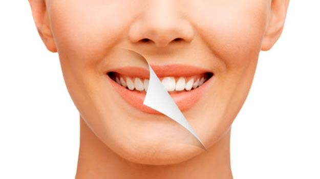 Before and After Results of Teeth Whitening